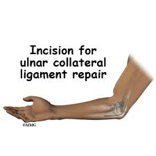 Mary mcmahon tommy john surgery is relatively common among baseball pitchers. Ulnar Collateral Ligament Reconstruction Tommy John Surgery Eorthopod Com