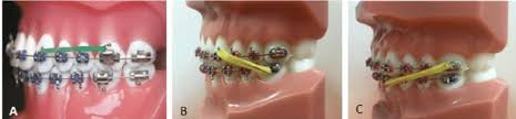 May hook to one upper tooth and two lower teeth, creating a triangle shape. Heavy Force Elastic Bands With Face Mask Download Scientific Diagram