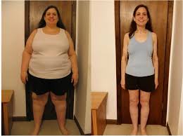 Gastric bypass surgery is the most common kind of weight loss surgery, and thus it can be one of the most important events in a person's life. Gastric Sleeve Before And After Pictures And What You Can Expect Bariatric Surgery Source