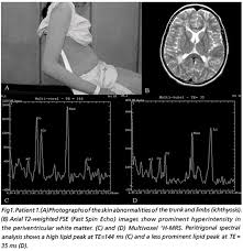 Mri And H Mrs Findings Of Three Patients With Sjogren Larsson Syndrome