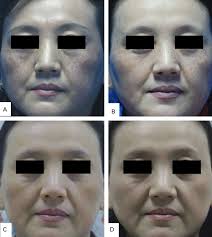 A Pilot Study of Intense Pulsed Light in the Treatment of Riehl's Melanosis