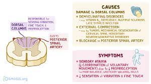 Posterior Cord Syndrome What Is It Causes Signs And Symptoms Diagnosis Treatment And More Osmosis