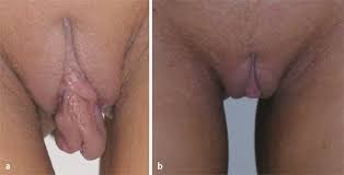 Entdecke die immer wachsende sammlung von hoch qualitativen am relevantesten xxx filme und clips. Asthetisch Plastische Chirurgie Der Weiblichen Genitalregion Springerlink