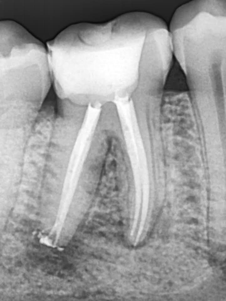 Root canal treatment (RCT)