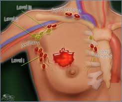 The Radiology Assistant Breast Cancer Staging And Treatment