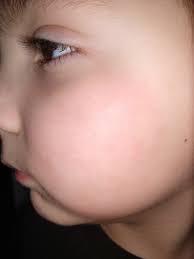 Kanye sparked concern when he was seen with mysterious red patches