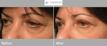As a los angeles oculoplastic surgeon, dr. Canthoplasty Photos Mehryar Ray Taban Md