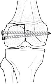 Image result for Growth Plate