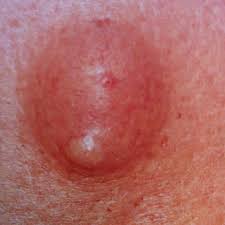 Quiste Sebaceo Sin Grasa Mejor Quiste Epidermico Cuaderno En Piel