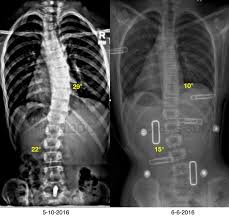 The Gensingen Brace Is A State Of The Art Scoliosis Brace Designed To Improve Posture And Cobb Angle In Growing Adoles Scoliosis Brace Scoliosis Spinal Surgery
