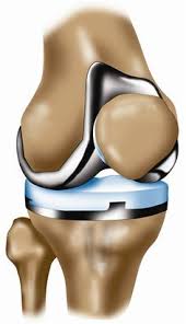 22 Best Stryker Orthopaedics Knee Replacement Systems Images