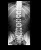 Check spelling or type a new query. Transverse Process Fracture Radiology Reference Article Radiopaedia Org