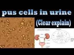 Pin On Pus Cells In Urine