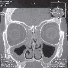 Coronal Ct Scan Of Paranasal Sinuses Showing Polypoidal Disease In The Download Scientific Diagram