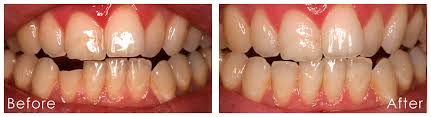 Veneers are usually made out of porcelain by a dental technician. Dental Veneers Cosmetic Dentistry