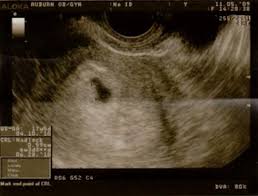 Ultimately it's your choice to have one or not. Detecting Twins With Ultrasound Is It Twins Or Not