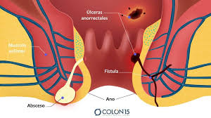 Abscesos Fistulas E Infecciones Anorrectales Colon15 Sevilla Centro Medico Avanzado