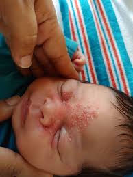 Preventive measures to avoid baby neck rash from occurring. Newborn S Rash Involves Eyes And Nose