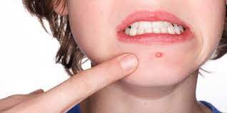 So, You Have A Pimple? Here's How To Get Rid Of It | Huffpost Life