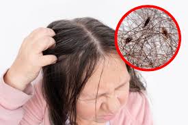 Image result for lice vs dandruff