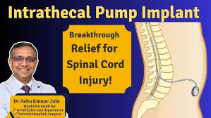 Image result for Intrathecal Pump