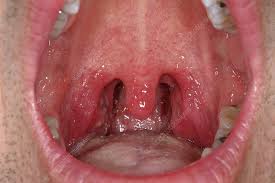 Image result for Tonsillitis
