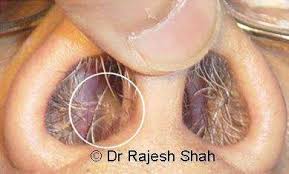Nasal polyps are benign (noncancerous) growths that may form inside nasal passages and sinuses — the spaces behind your nose and cheeks. Nasal Polyps Homeopathic Treatment Symptoms