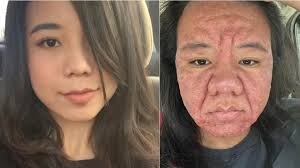 Pregnancy and its significant physical changes. —————————- A 28-year-old  Malaysian woman recently shared her remarkable transformation during  pregnancy, which resulted in inflammation and wrinkles on her face, similar  to those of an