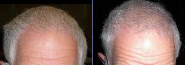 Stress is one of the leading causes of hair loss and thinning. Vitamin D Reduces Hair Loss Vitamindwiki