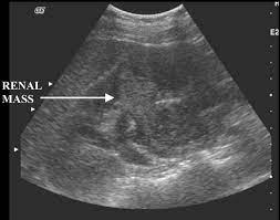 Dermatological conditions seen in renal transplant recipients in a singapore tertiary hospital. Atypical Presentation Of Renal Cell Carcinoma A Case Report Journal Of Medical Case Reports Full Text