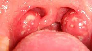 Sore throat and hoarseness that persists for more than two weeks. Sore Throat Treatment Causes Diagnosis Symptoms More