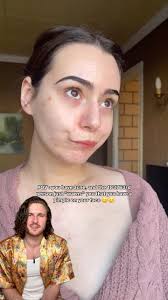 YOU don’t need tell us we have acne, we know 🙄😓 @selflove_aida #acne  #skincare #acnetreatment #pimples #skinpositivity #acnepositivity  #skincareaddict #teamacne