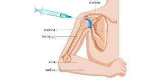 Image result for Shoulder Injection