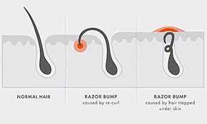 6 Home Remedies To Get Rid Of Razor Bumps Fast - Skin Beauty