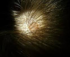 Braune Flecken Auf Der Haut Was Verbirgt Sich Dahinter Familien Welt De