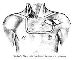 Https Www Nieren Hamburg De Images Pdf Dialyse 148 Shunt Johnsen Pdf