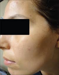 Acne on the cheeks may also be linked to exposure to a dirty phone or pillowcase, or other habits. View Image