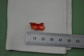 ミルメシア 治療