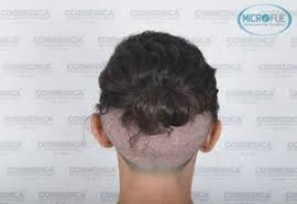 Con la sessione di trapianto di capelli con il metodo fue senza tagliare dei capelli il/la interessato /a ha la possibilità di ripristinare . Rasare I Capelli Per Il Trapianto