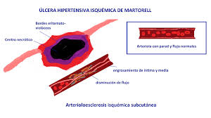 • das ulcus hypertonicum martorell gehört zu den häufigen ursachen chronischer wunden am unterschenkel. Key Elements To Understanding Martorell Ulcer Elena Conde Montero