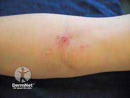 Image result for Pathergy