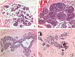 A type of cancer in which the epithelial cells of the kidney grow uncontrollably. Lobular Carcinoma In Situ Diagnostic Criteria And Molecular Correlates Modern Pathology