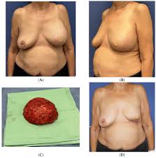 Image result for Mastectomy