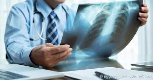 Lungenkrebs Bronchialkarzinom Warnsignale Therapie Netdoktor