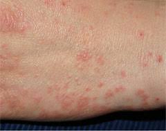 Image result for scabies human children