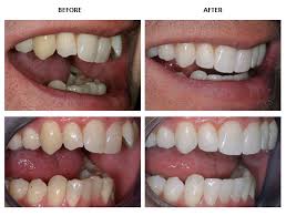 Invisalign promises to correct your teeth without installing metal hardware, and its subtle appearance makes it ideal for older teens and adults that don't want to be seen with braces. Inman Aligner Before And After Pictures Inman Aligner