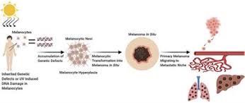 Watch out for moles that are Frontiers Decoding Melanoma Development And Progression Identification Of Therapeutic Vulnerabilities Oncology