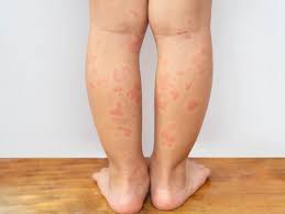 Image result for vyrážka u dětí