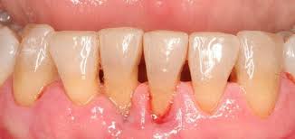 The body's immune system fights the bacteria as the plaque spreads and grows below the. Periodontitis Disease Periodontitis Stages And Treatments Dentist In Santa Rosa