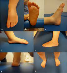 J bone joint surg am. Is Unilateral Lower Leg Orthosis With A Circular Foot Unit In The Treatment Of Idiopathic Clubfeet A Reasonable Bracing Alternative In The Ponseti Method Five Year Results Of A Supraregional Paediatric Orthopaedic Centre